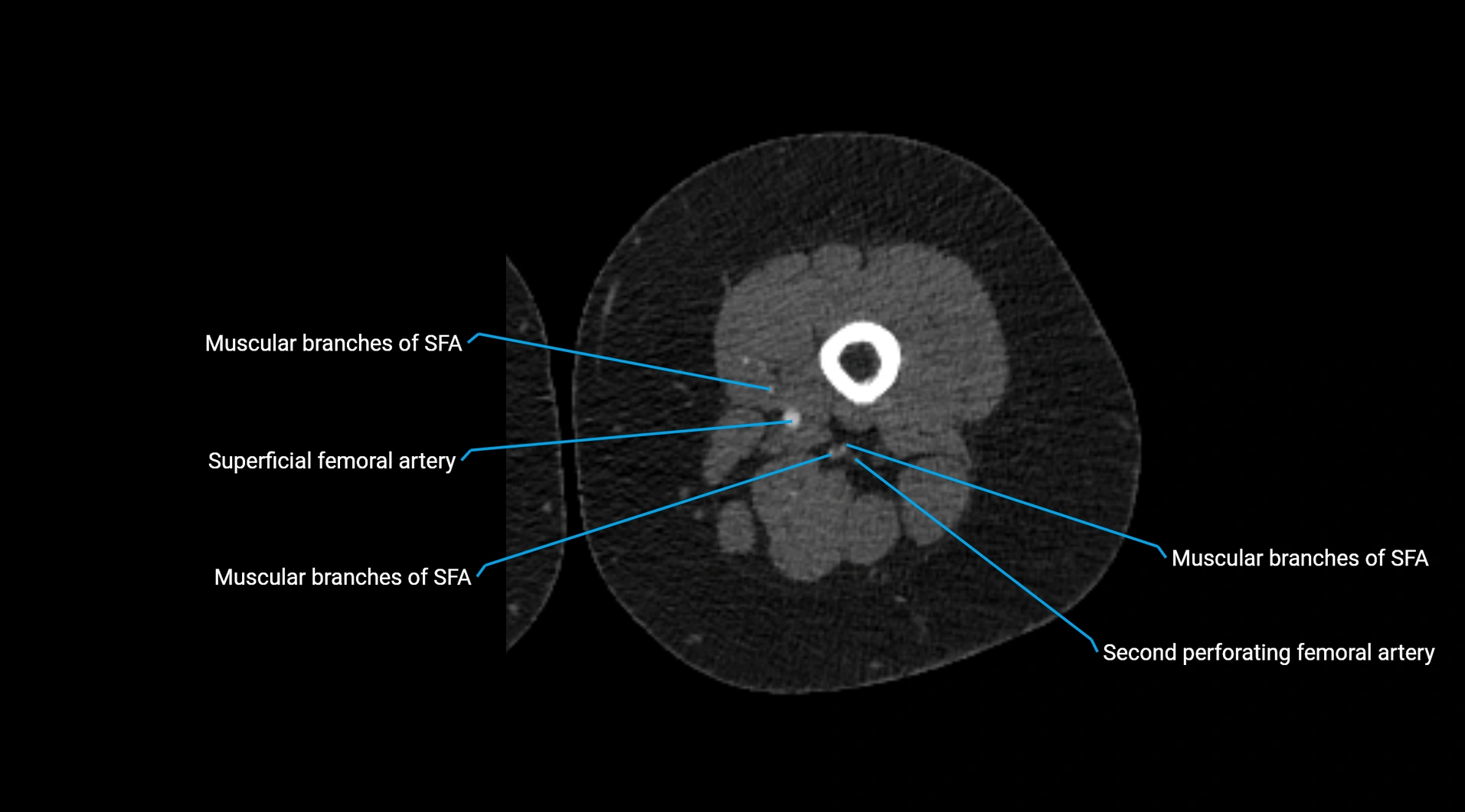 CTA lower limb cross sectional anatomy labelled image _137.webp